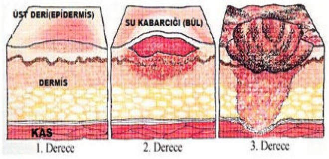 yanik-dereceleri-002.jpg